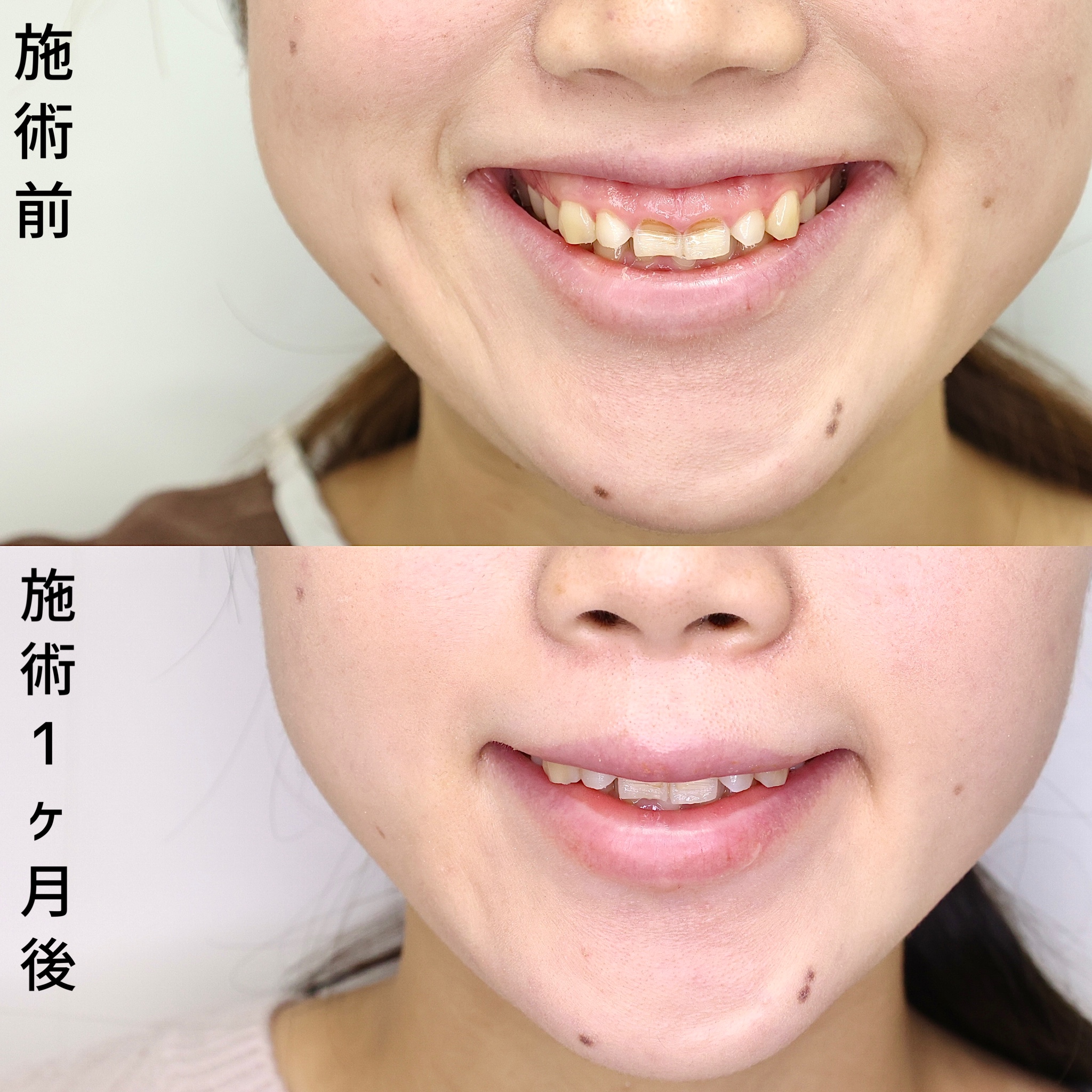 ガミースマイル切開法/ボトックス注射：その他の症例写真 施術前後 