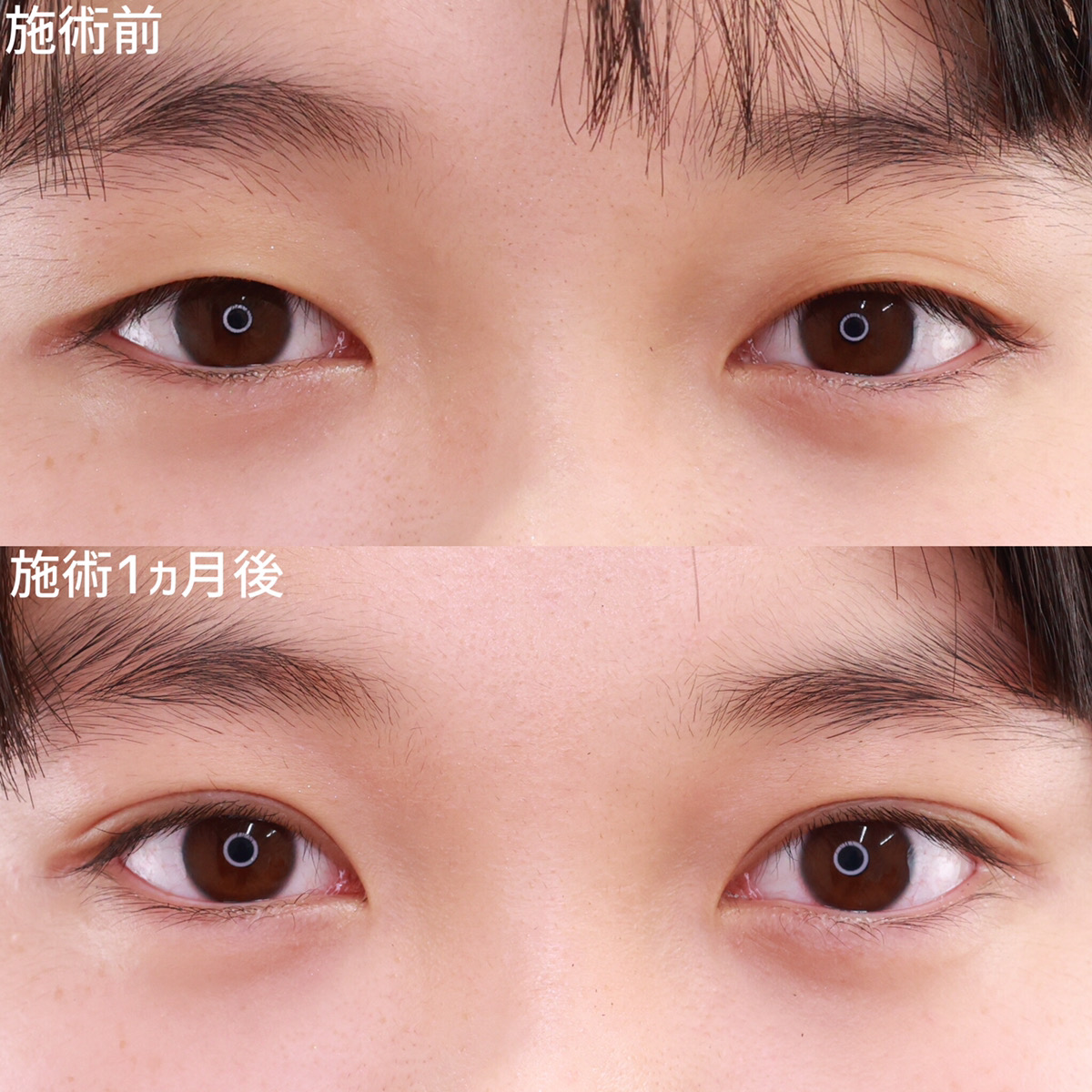 二重埋没法/目元:その他の症例写真 施術前後