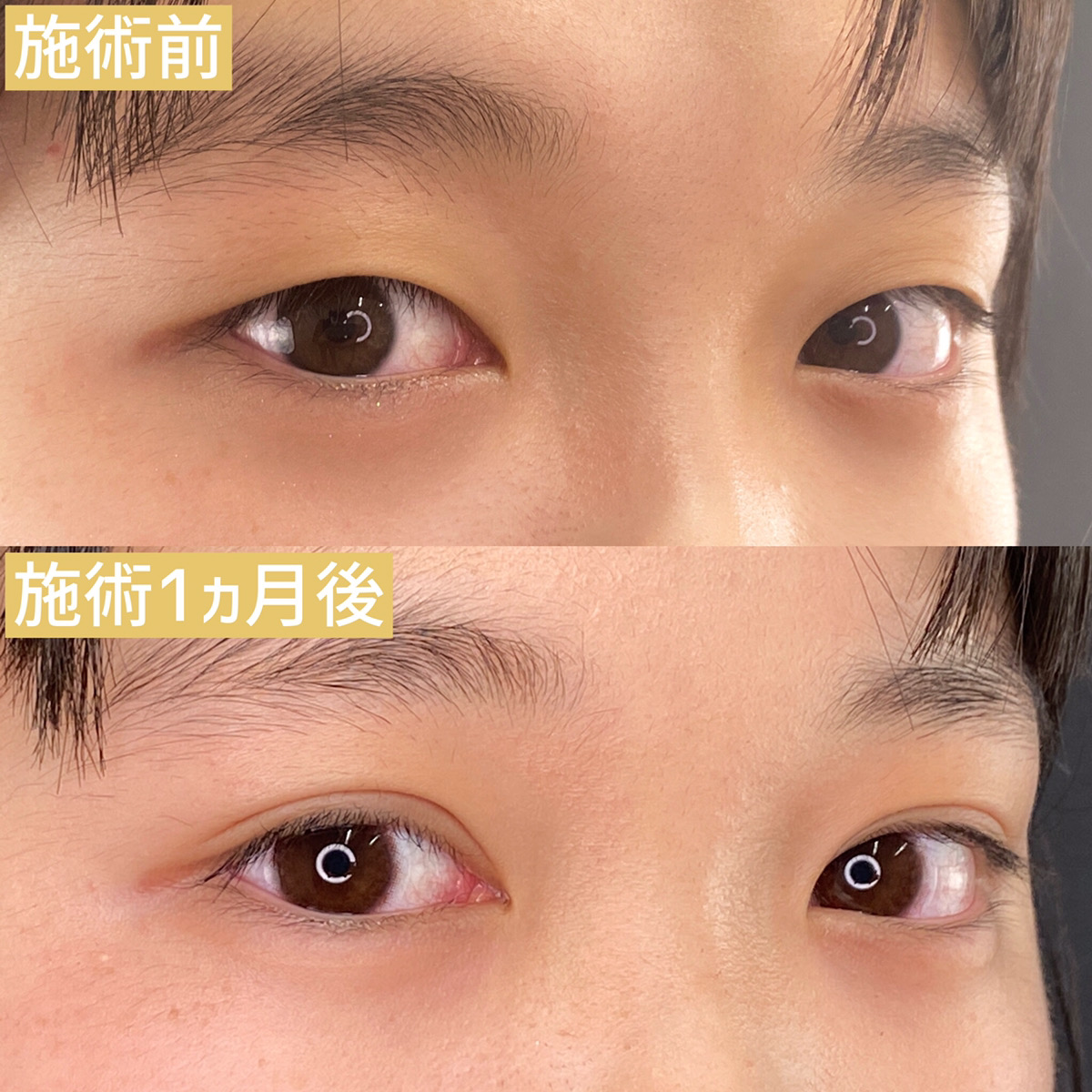 二重埋没法/目元:その他の症例写真 施術前後