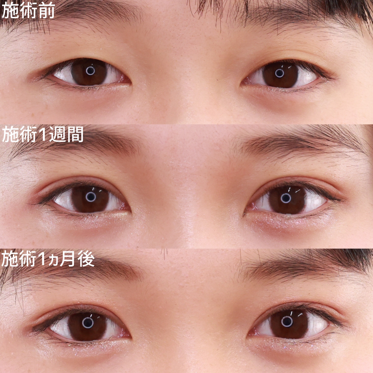 二重埋没法/目元:その他の症例写真 施術前後