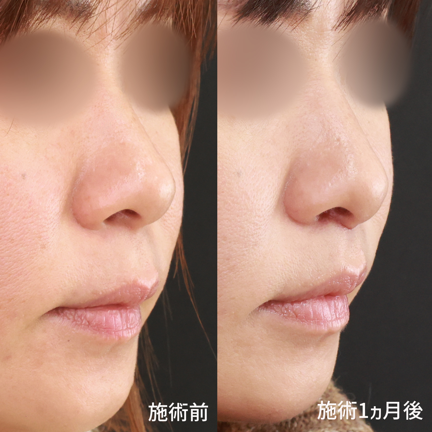 人中短縮術(リップリフト)・外側人中短縮術の症例写真 施術前後 