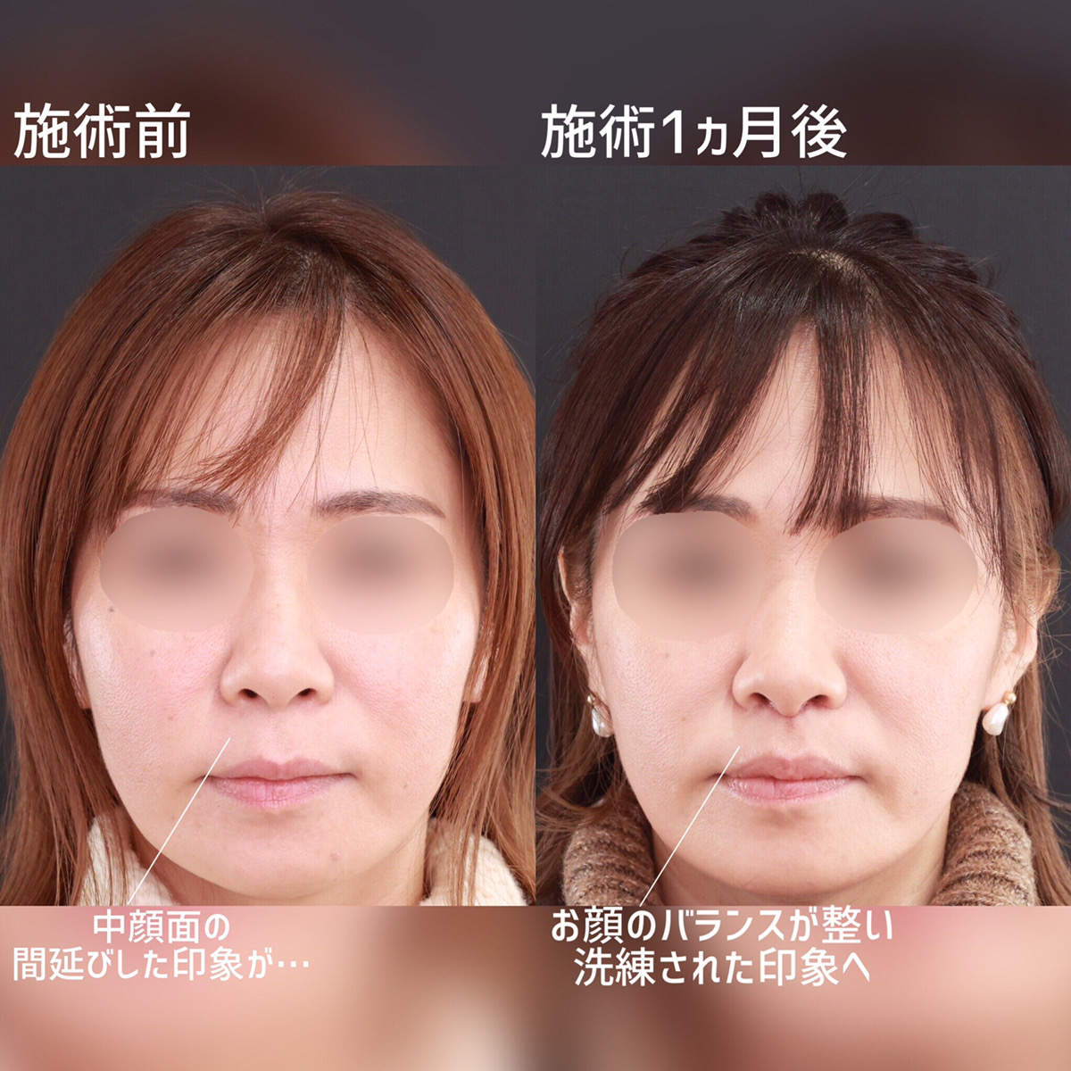 人中短縮術(リップリフト)・外側人中短縮術の症例写真 施術前後 