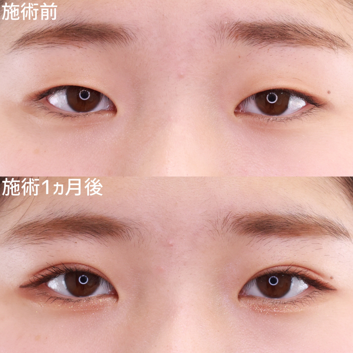 二重埋没法/目元:その他の症例写真 施術前後