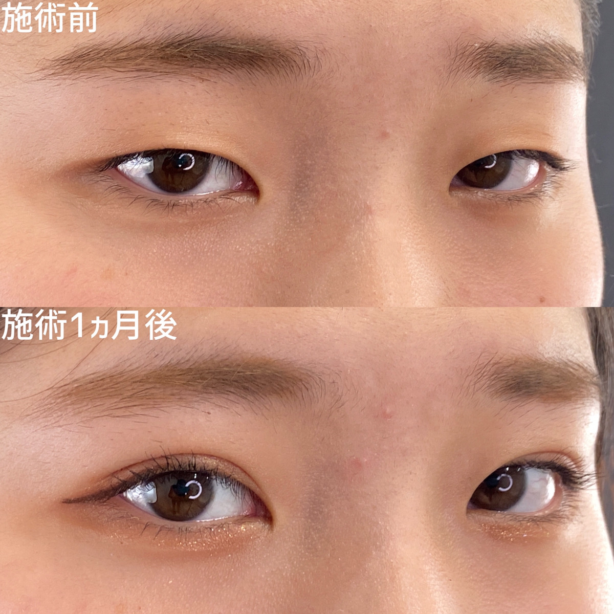 二重埋没法/目元:その他の症例写真 施術前後