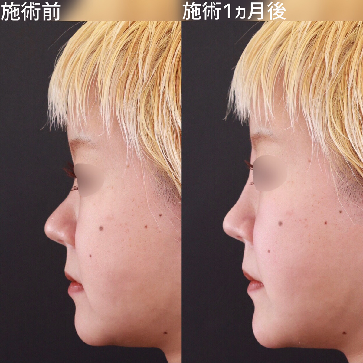 鼻のヒアルロン酸注射/顎のヒアルロン酸注射の症例写真 施術前後 