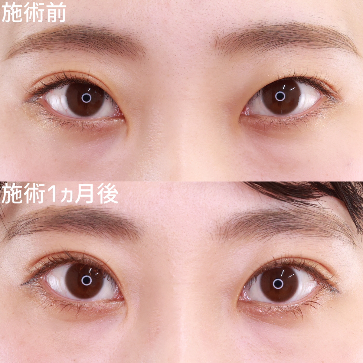 ナチュラルで大人な雰囲気を出す二重埋没法