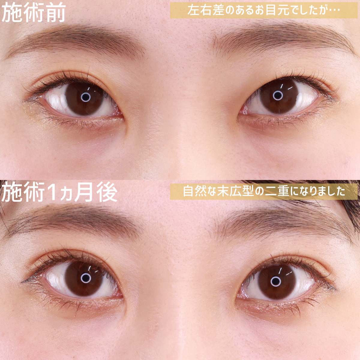 二重埋没法の症例写真 施術前後 