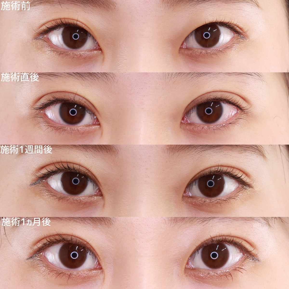 二重埋没法の症例写真 施術前後 