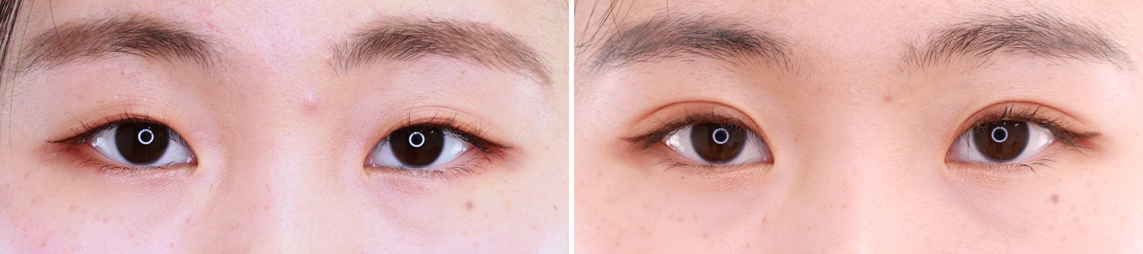 埋没法で大人可愛い二重に変身！