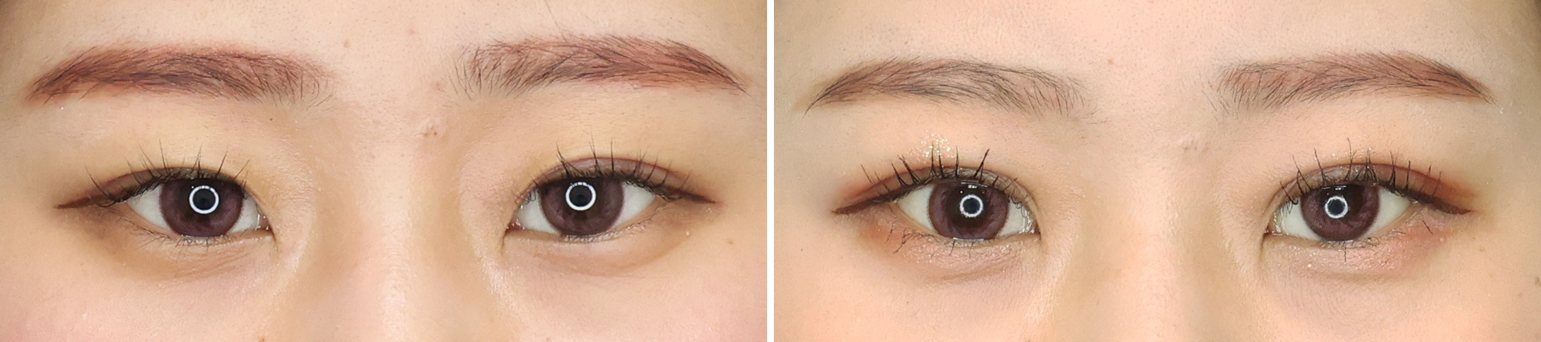 左右不揃いだった末広二重。【埋没法】で目力アップの平行二重に！