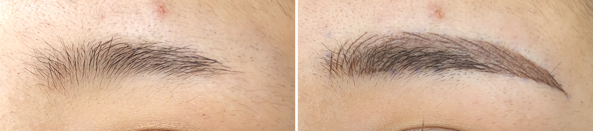 TACメディカルアートメイク（眉・アイライン・リップ）の症例写真 施術前後 直後