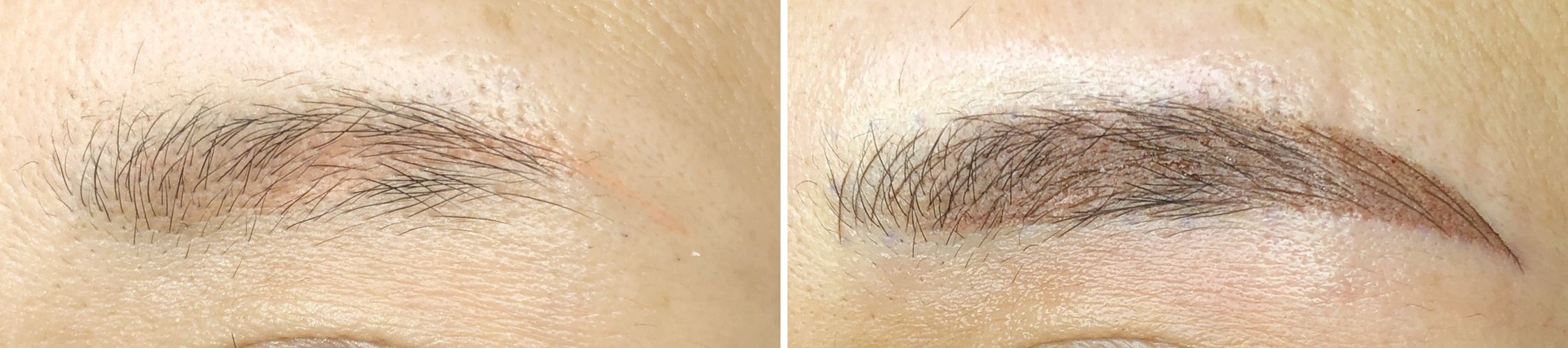 TACメディカルアートメイク（眉・アイライン・リップ）の症例写真 施術前後 直後