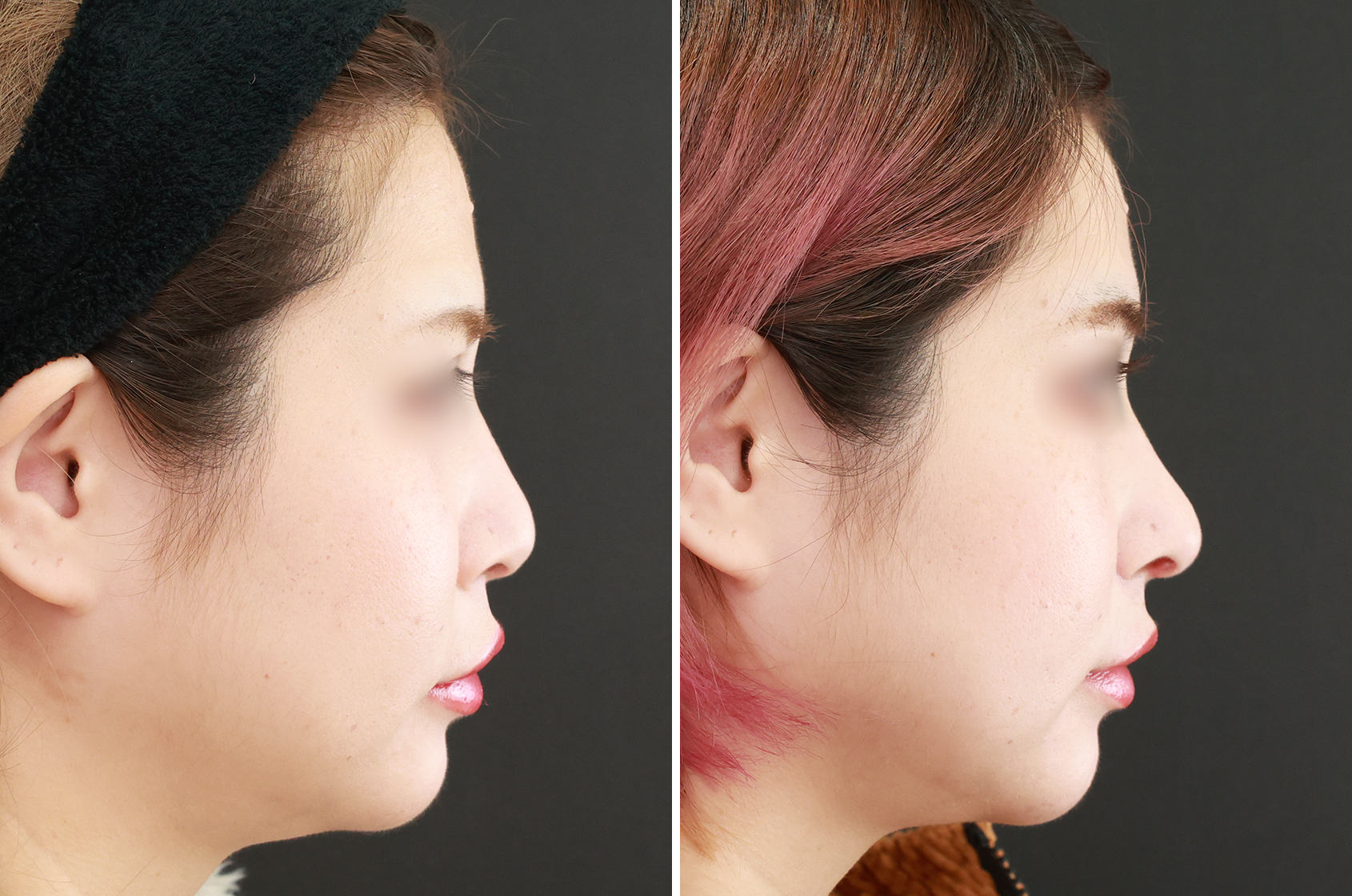TAC式 鼻翼縮小術（小鼻縮小）/鼻尖形成・鼻尖縮小/鼻中隔延長術の症例写真 施術前後 １ヵ月
