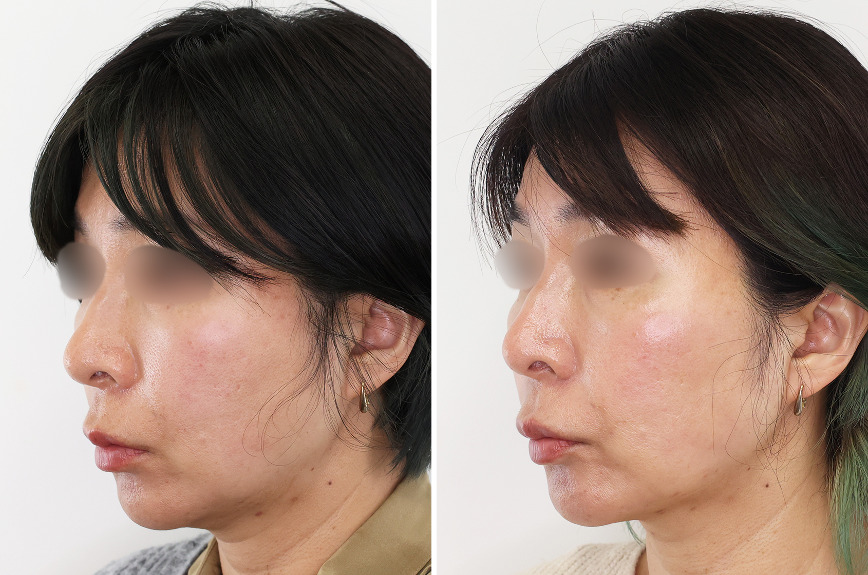 お顔のたるみに気づいたら 綺麗になれるチャンス！【糸リフト×口横脂肪除去】