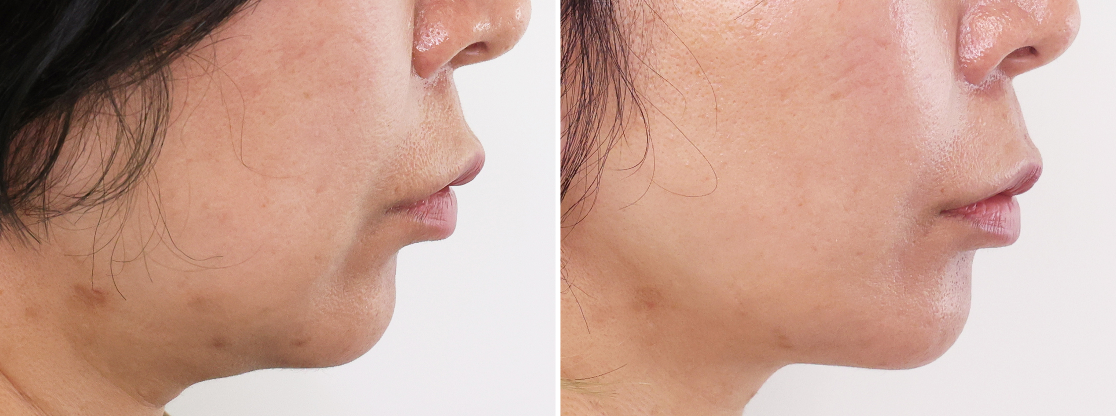 TAC式 ツヤ肌コラーゲンリフト®/ジョールファット除去の症例写真 施術前後 ３ヵ月