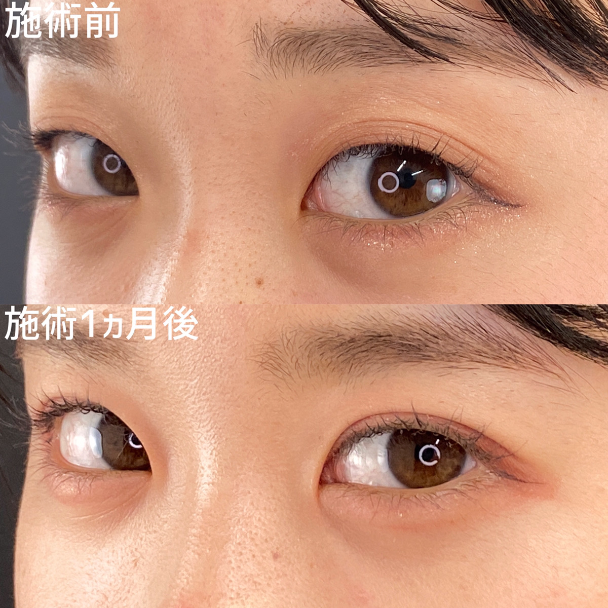 二重埋没法/目元：その他の症例写真 施術前後 