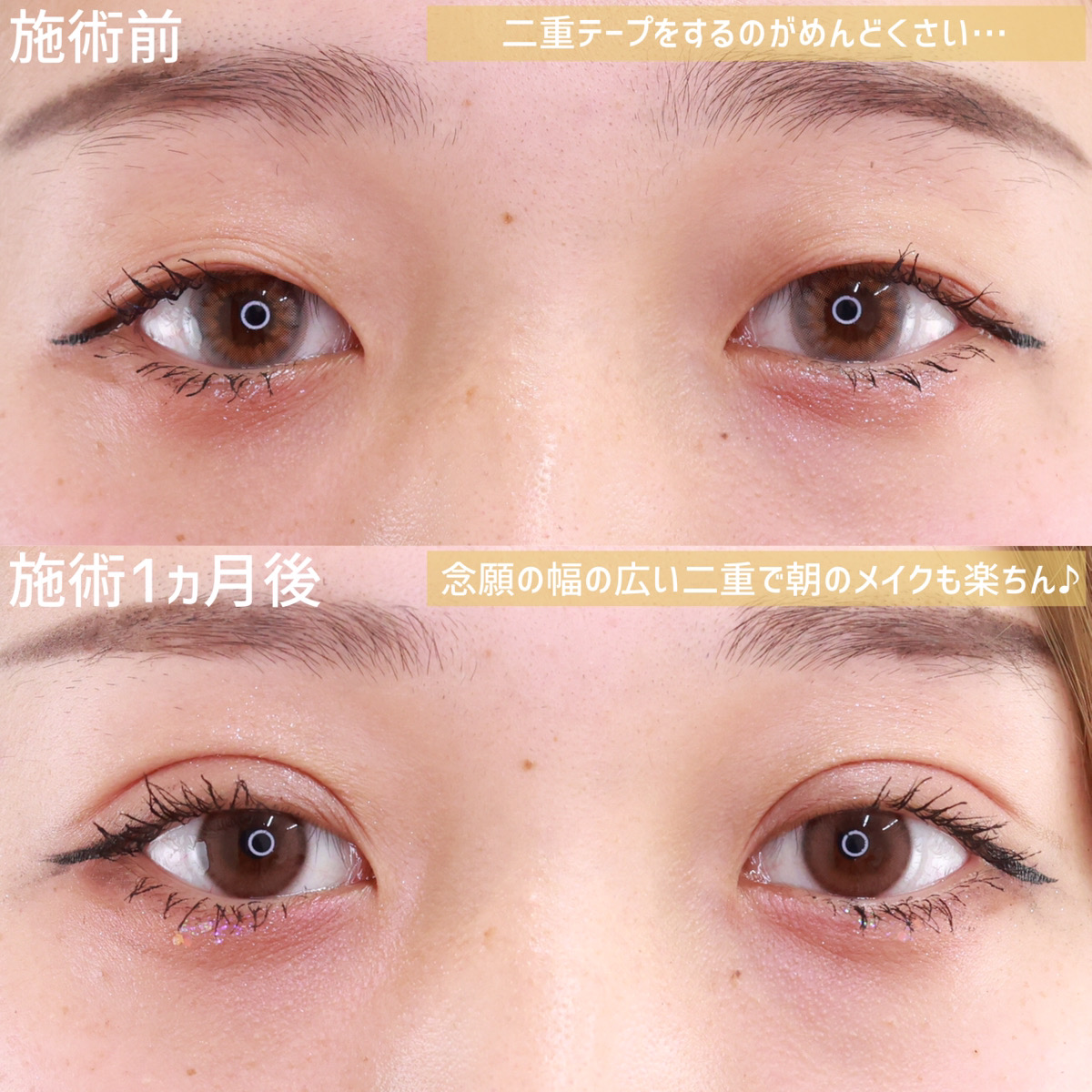 二重埋没法/目元：その他の症例写真 施術前後 