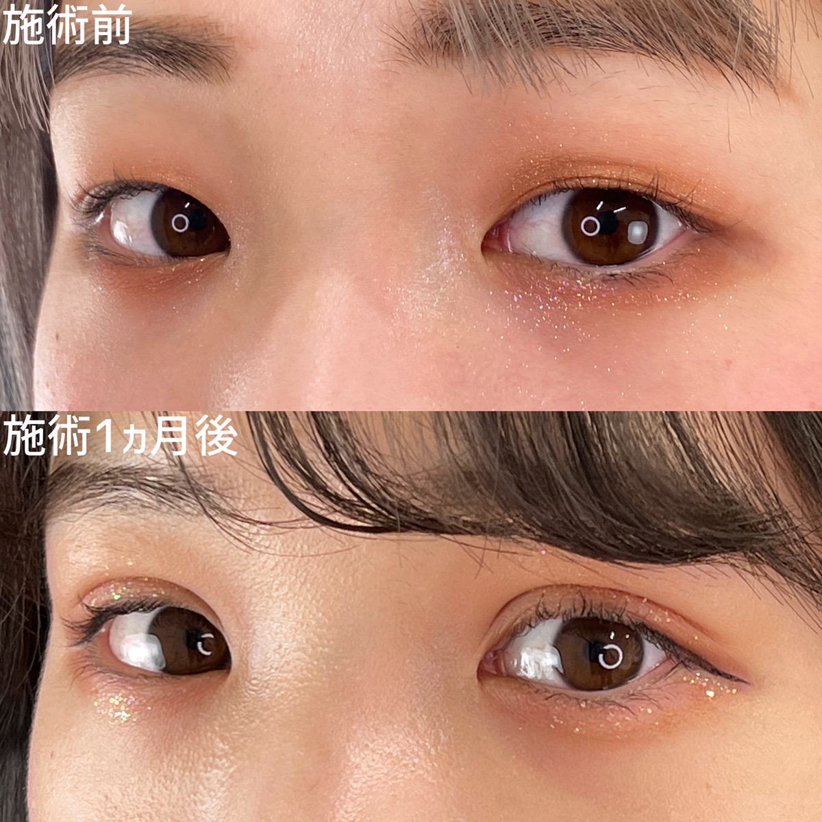 二重埋没法の症例写真 施術前後