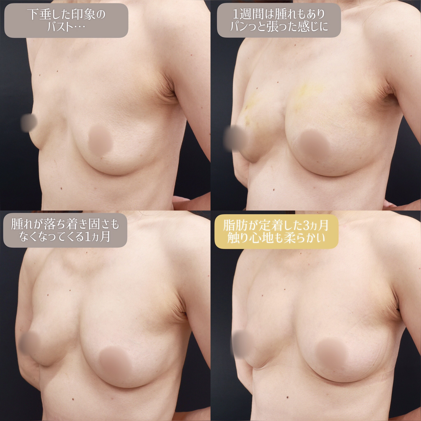 脂肪注入豊胸（コンデンスリッチ・ピュアグラフト・１day脂肪豊胸）の症例写真 施術前後 術前～1週間～1ヵ月～3ヵ月