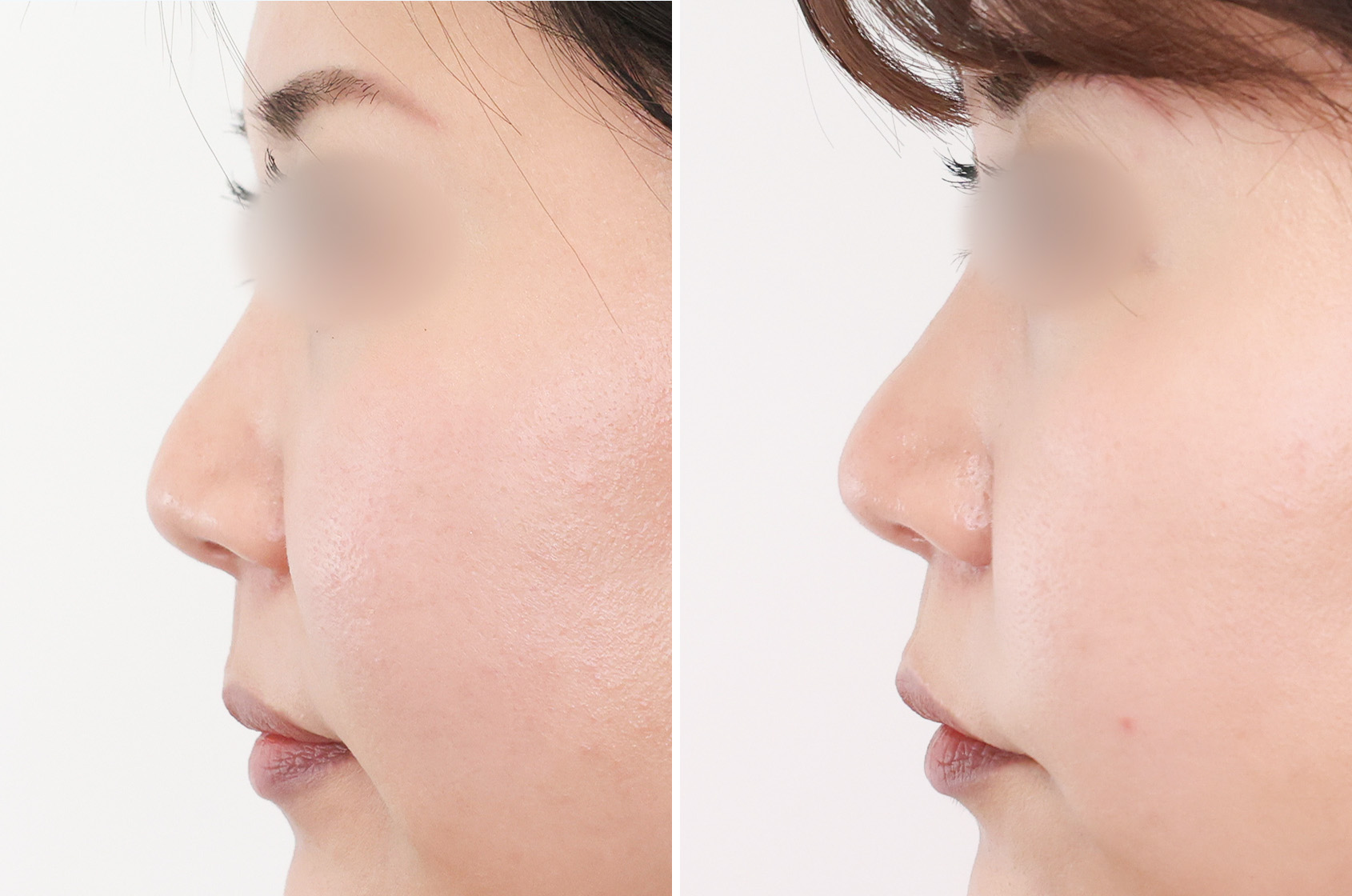 シュッとスリムな小鼻に！ダウンタイムを短くしたい人におすすめの鼻施術