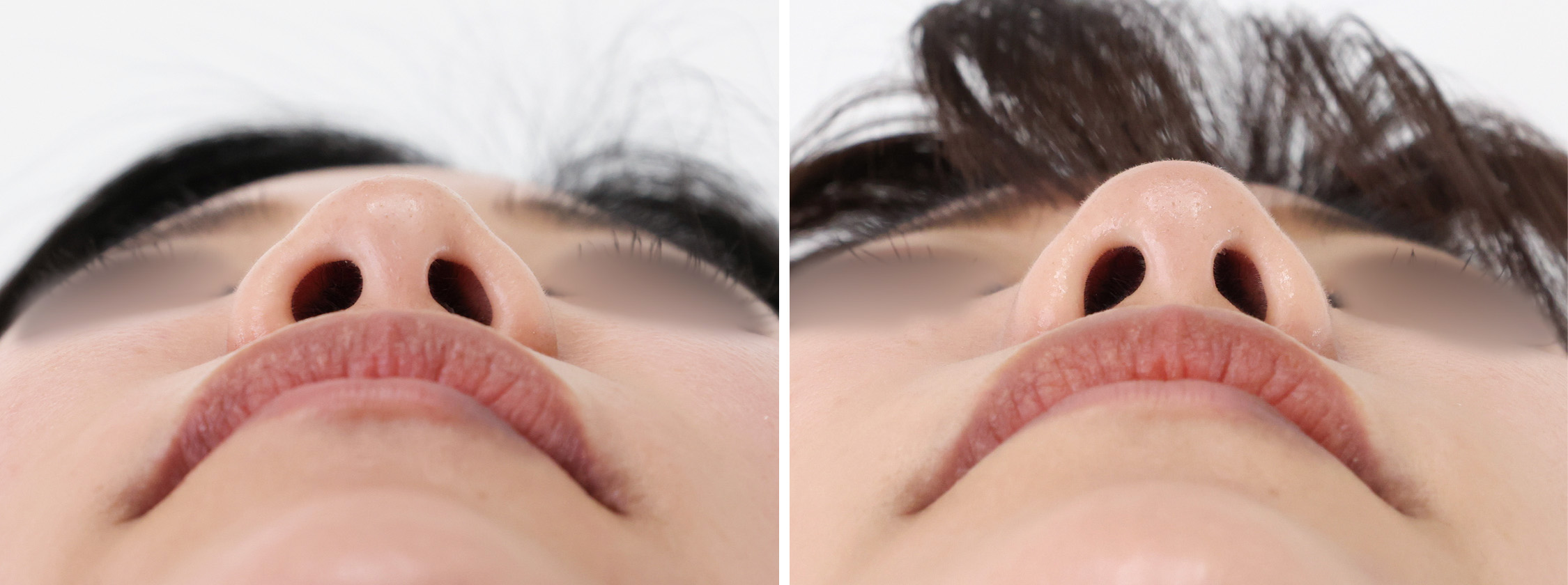 鼻尖形成・鼻尖縮小/TAC式 鼻翼縮小術（小鼻縮小）/鼻尖4Dノーズの症例写真 施術前後 ３ヵ月