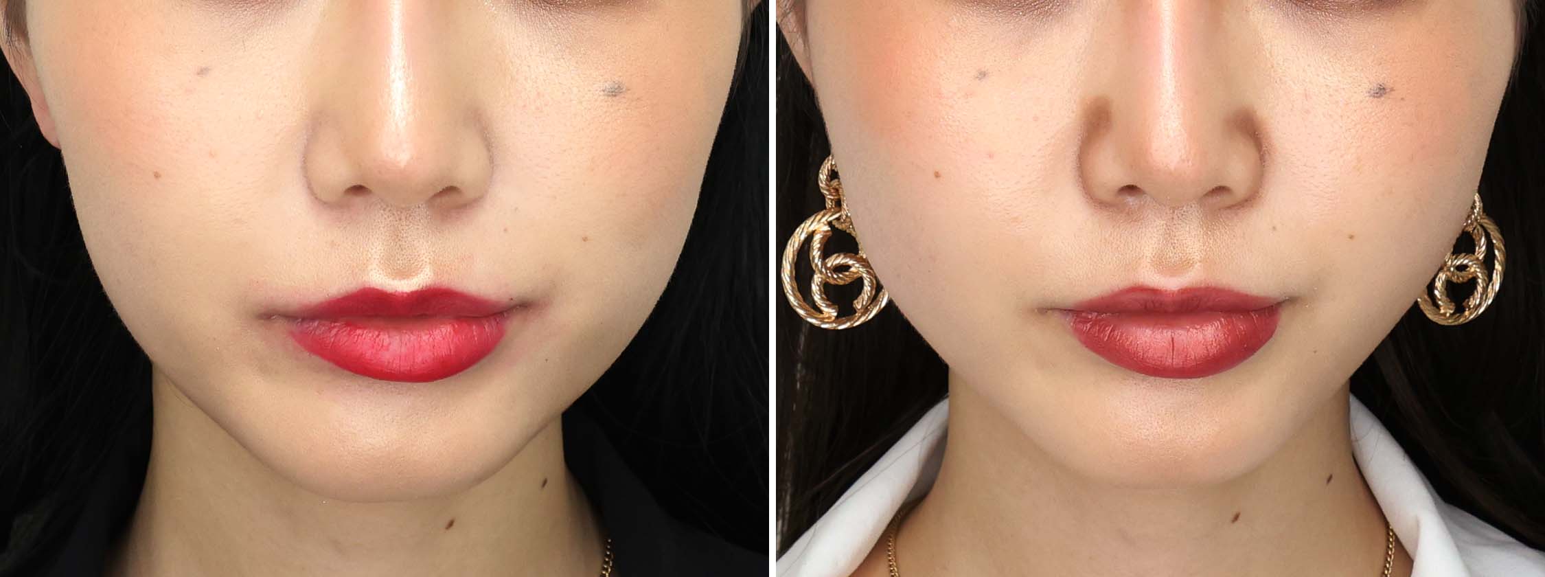 TAC式 ツヤ肌コラーゲンリフト®/バッカルファット除去の症例写真 施術前後 １週間