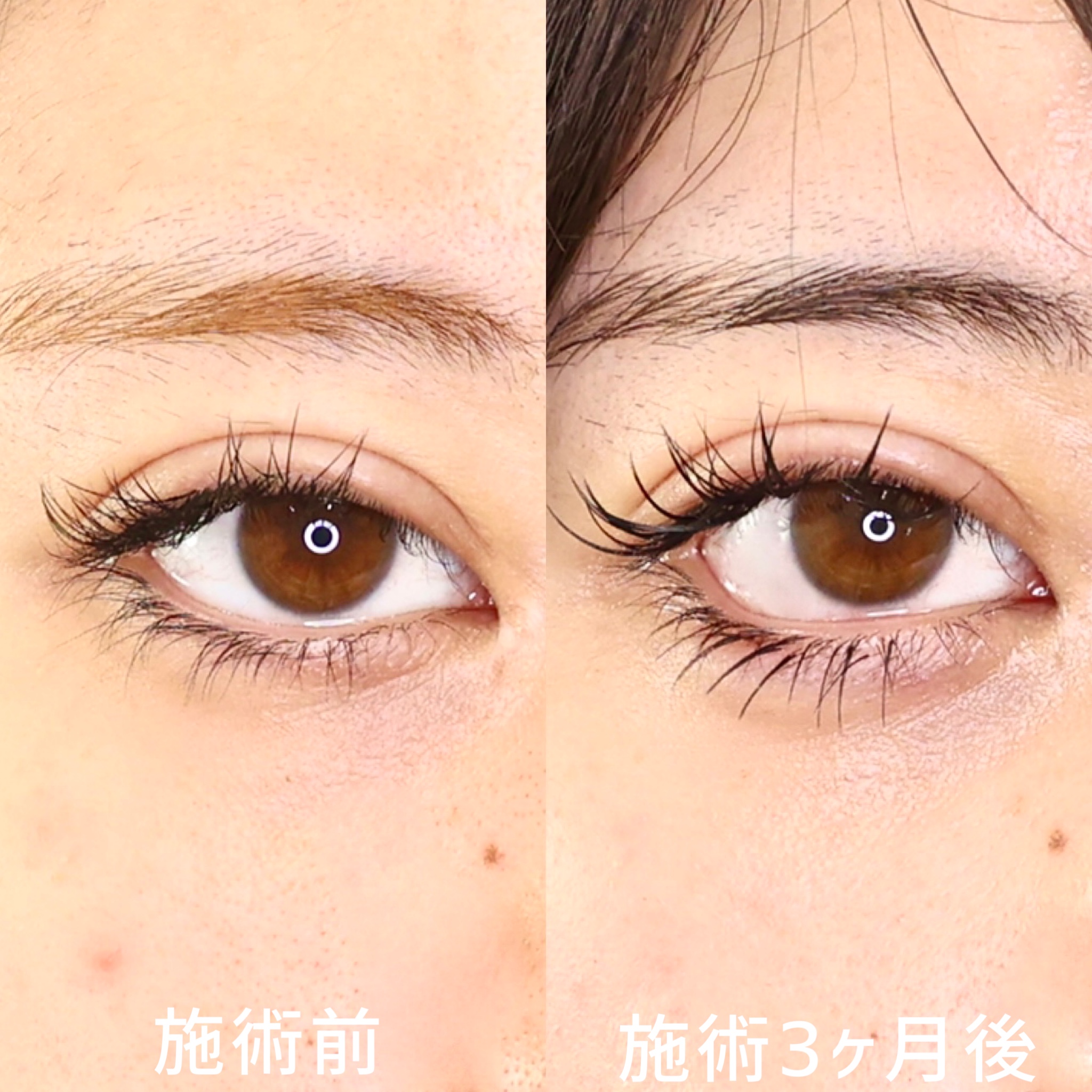 グラマラスライン（タレ目形成）の症例写真 施術前後 3ヵ月