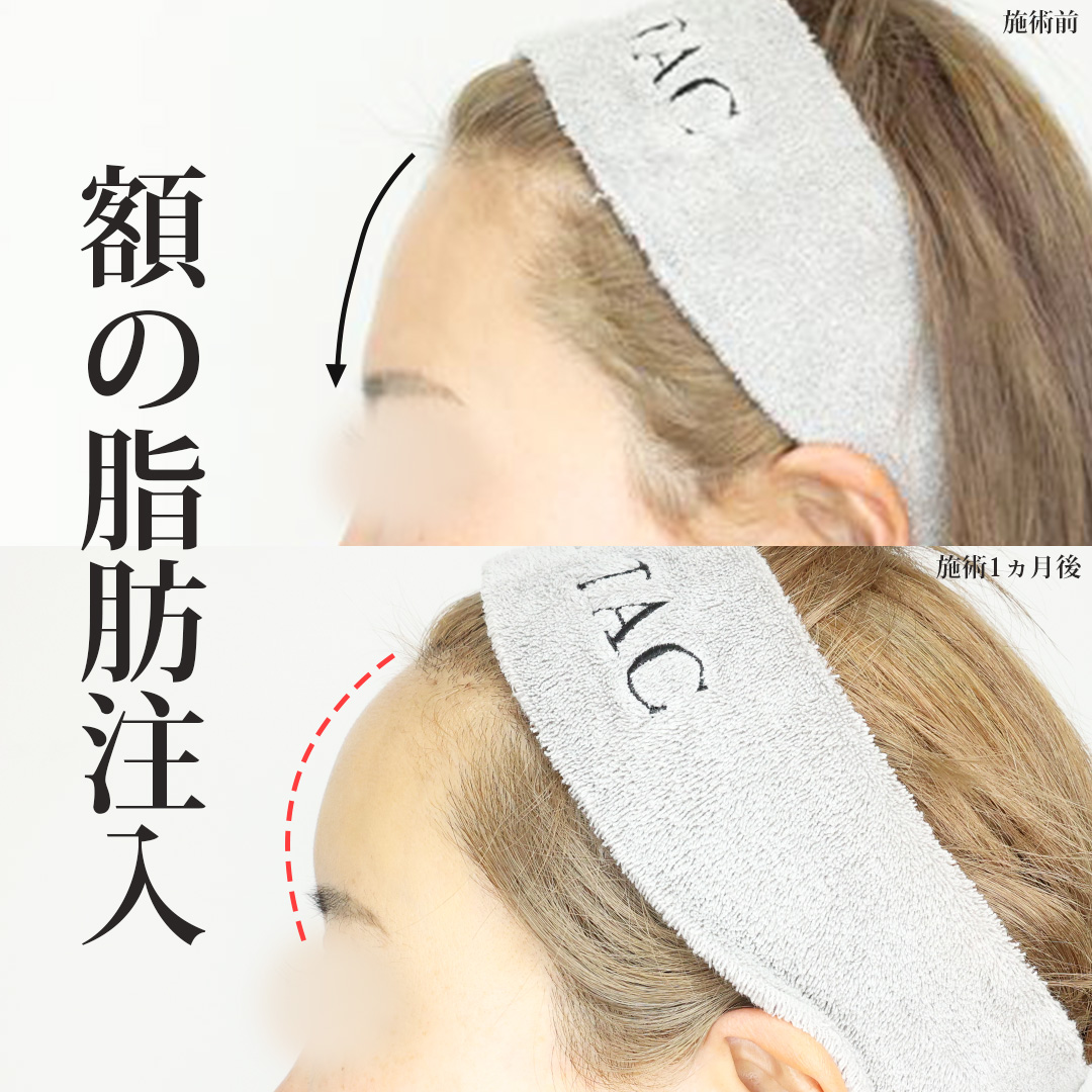 顔の脂肪注入(コンデンスリッチフェイス)の症例写真 施術前後 