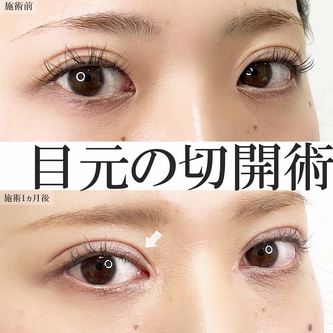 上眼瞼切開術/目頭切開術の症例写真 施術前後
