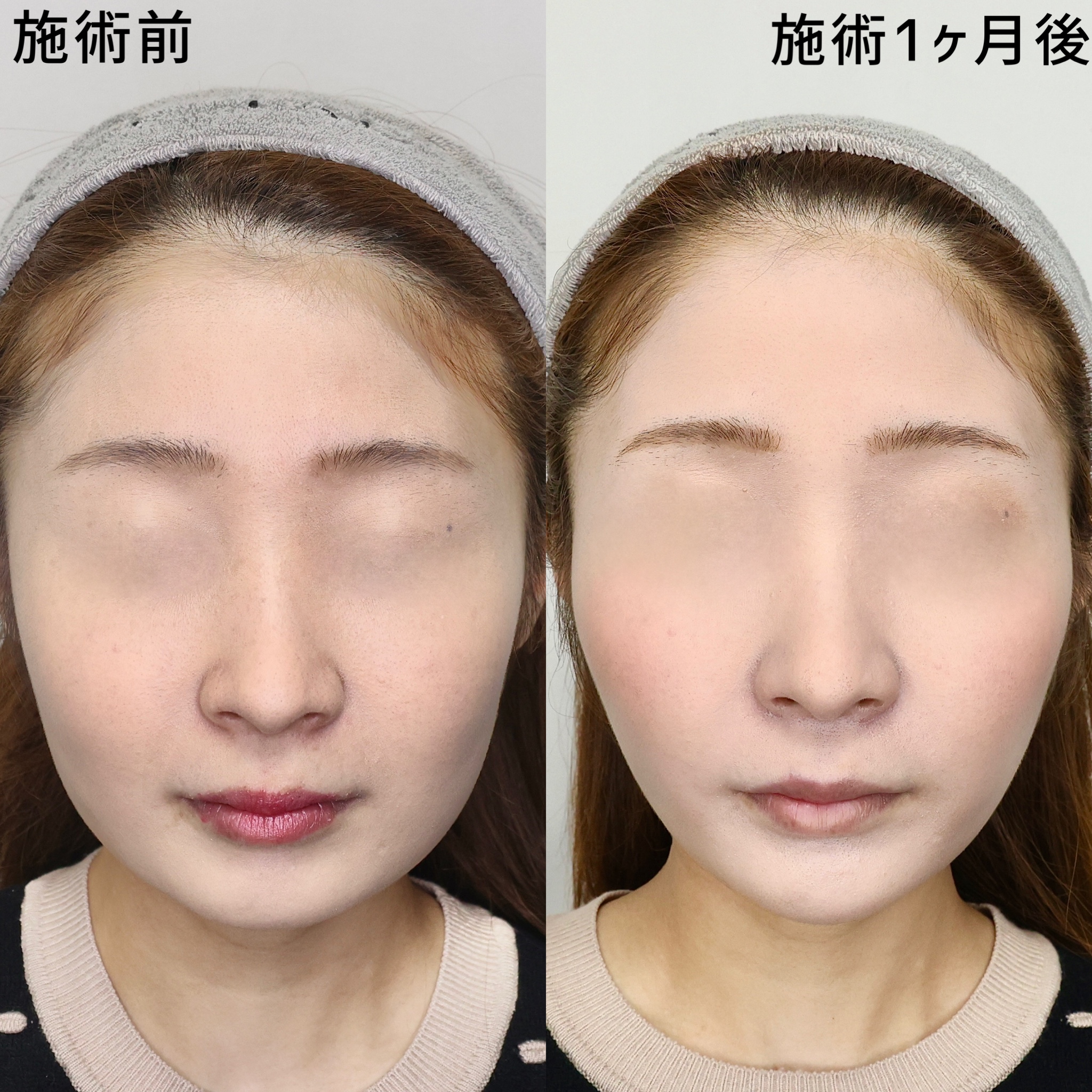 【糸リフト×脂肪除去】マスクを取っても自信の持てる小顔へ