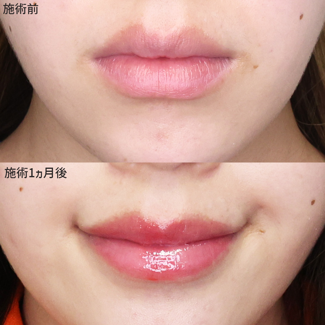 口角挙上・リフト（マイクロ切開法・内側法/口内法）の症例写真 施術前後 