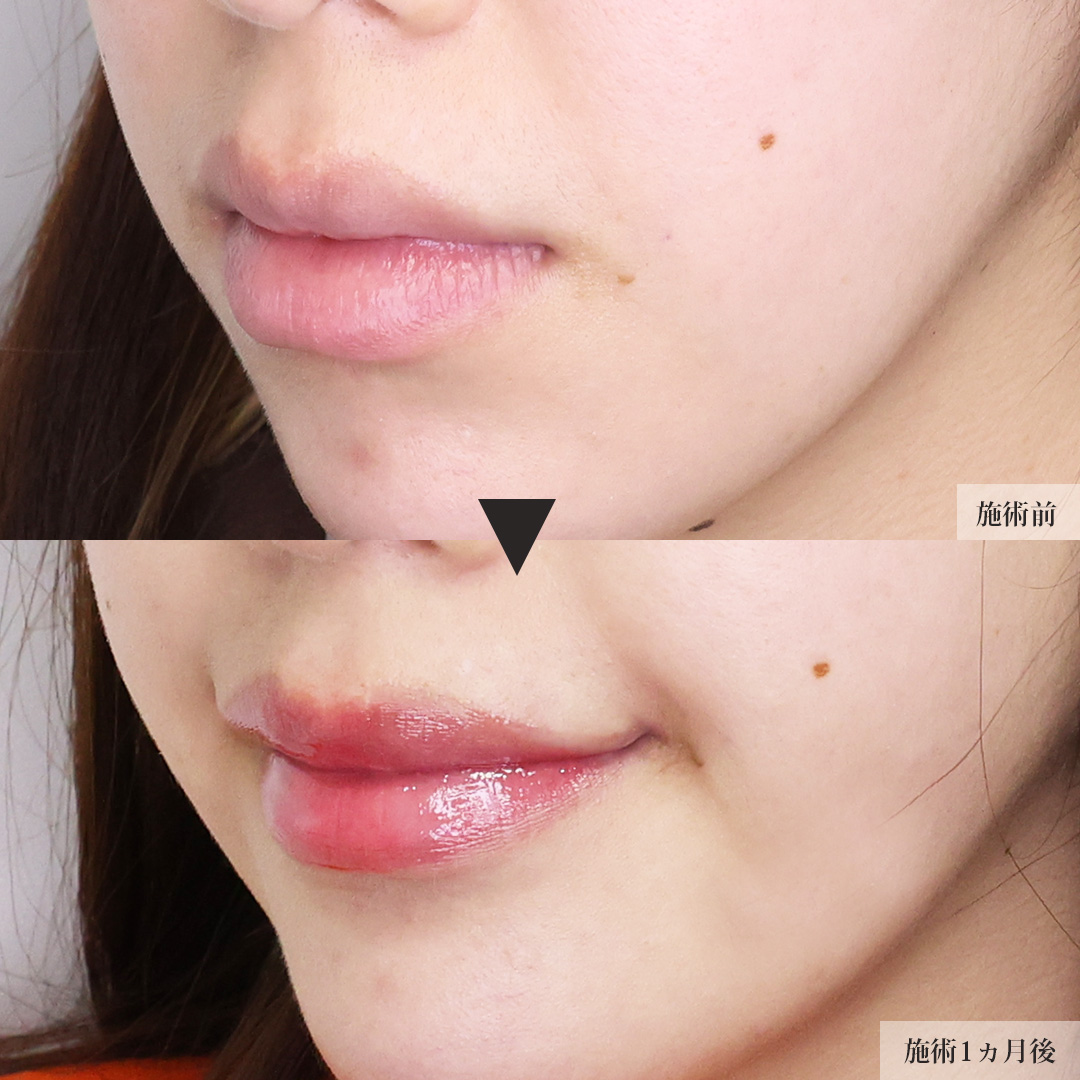 口角挙上・リフト（マイクロ切開法・内側法/口内法）の症例写真 施術前後 