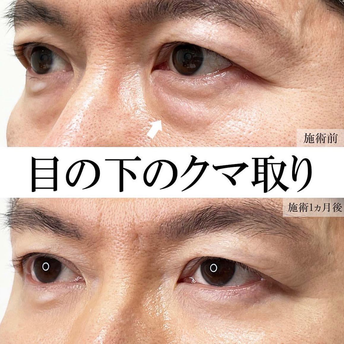 下眼瞼脱脂術（目の下のたるみ取り・目の下の脂肪ふくらみ取り）/目の下のヒアルロン酸注射の症例写真 施術前後 