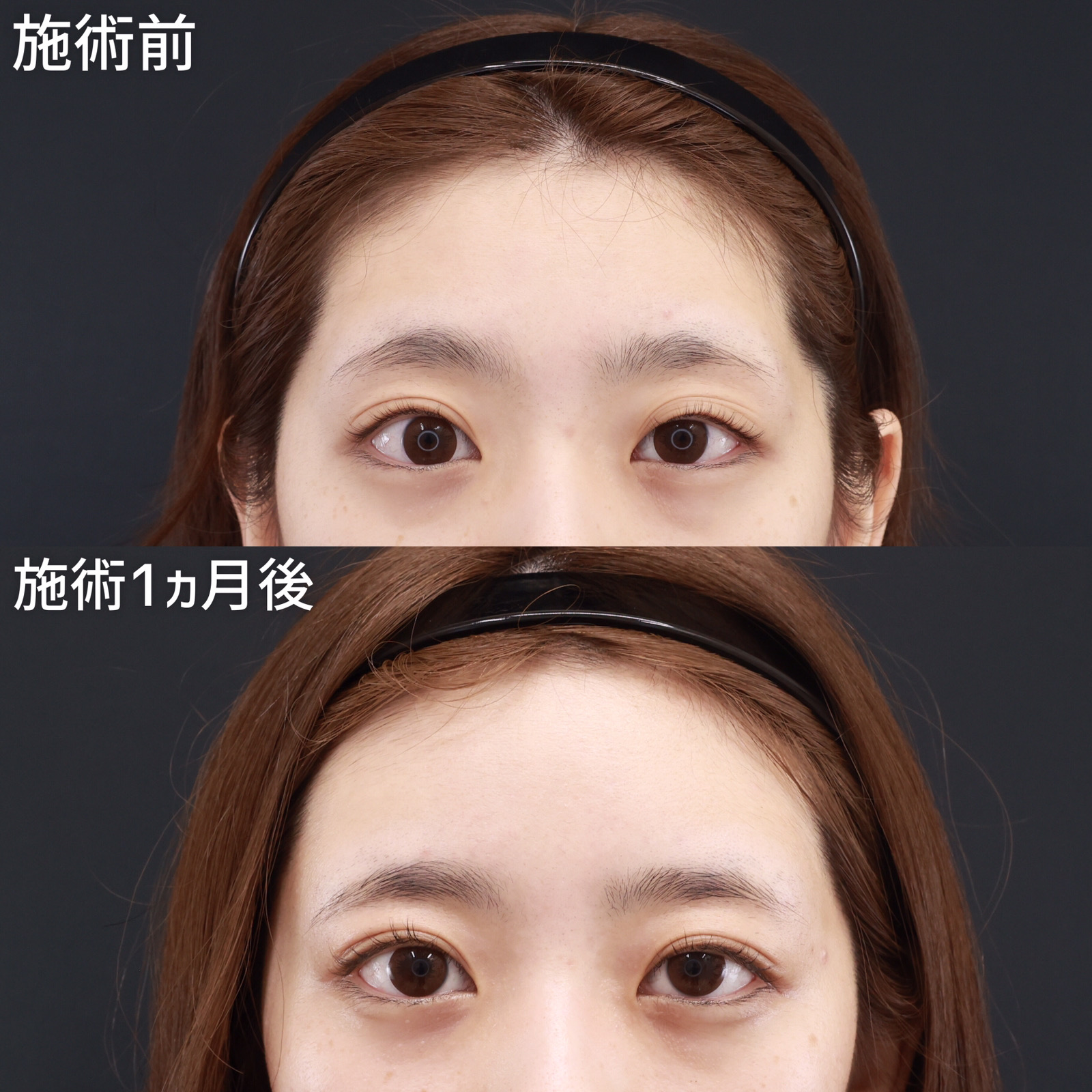 おでこの脂肪注入(オルチャンデコ形成)/顔の脂肪注入(コンデンスリッチフェイス)の症例写真 施術前後