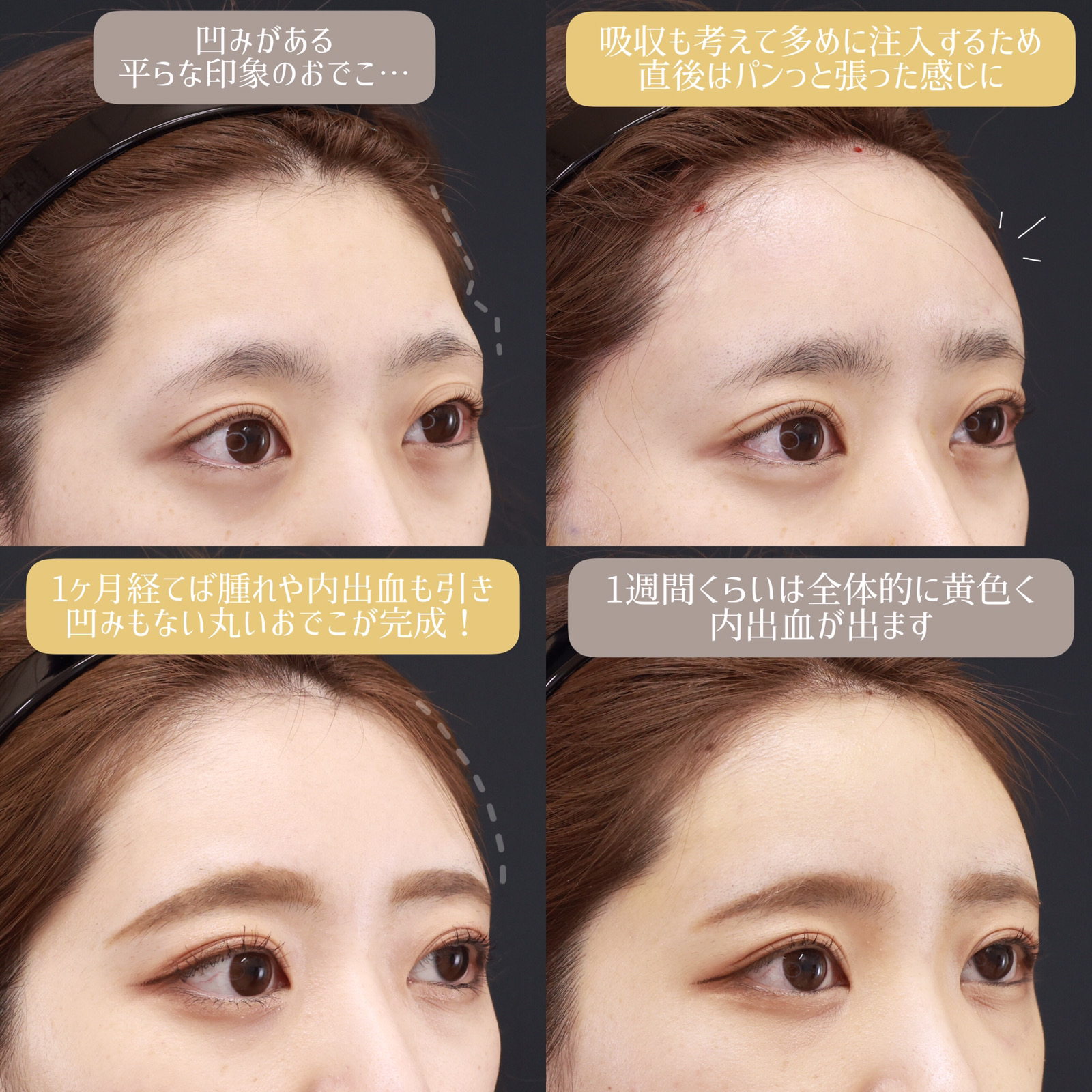 おでこの脂肪注入(オルチャンデコ形成)/顔の脂肪注入(コンデンスリッチフェイス)の症例写真 施術前後