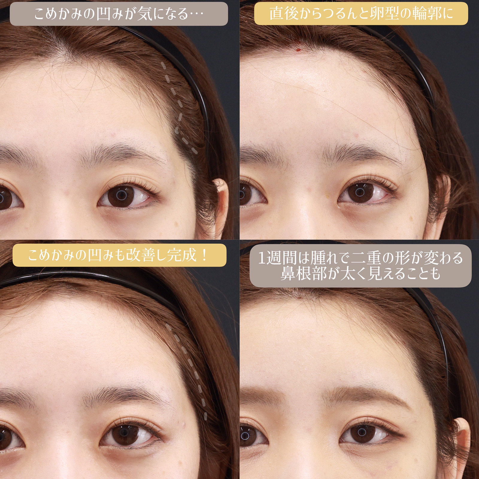 おでこの脂肪注入(オルチャンデコ形成)/顔の脂肪注入(コンデンスリッチフェイス)の症例写真 施術前後