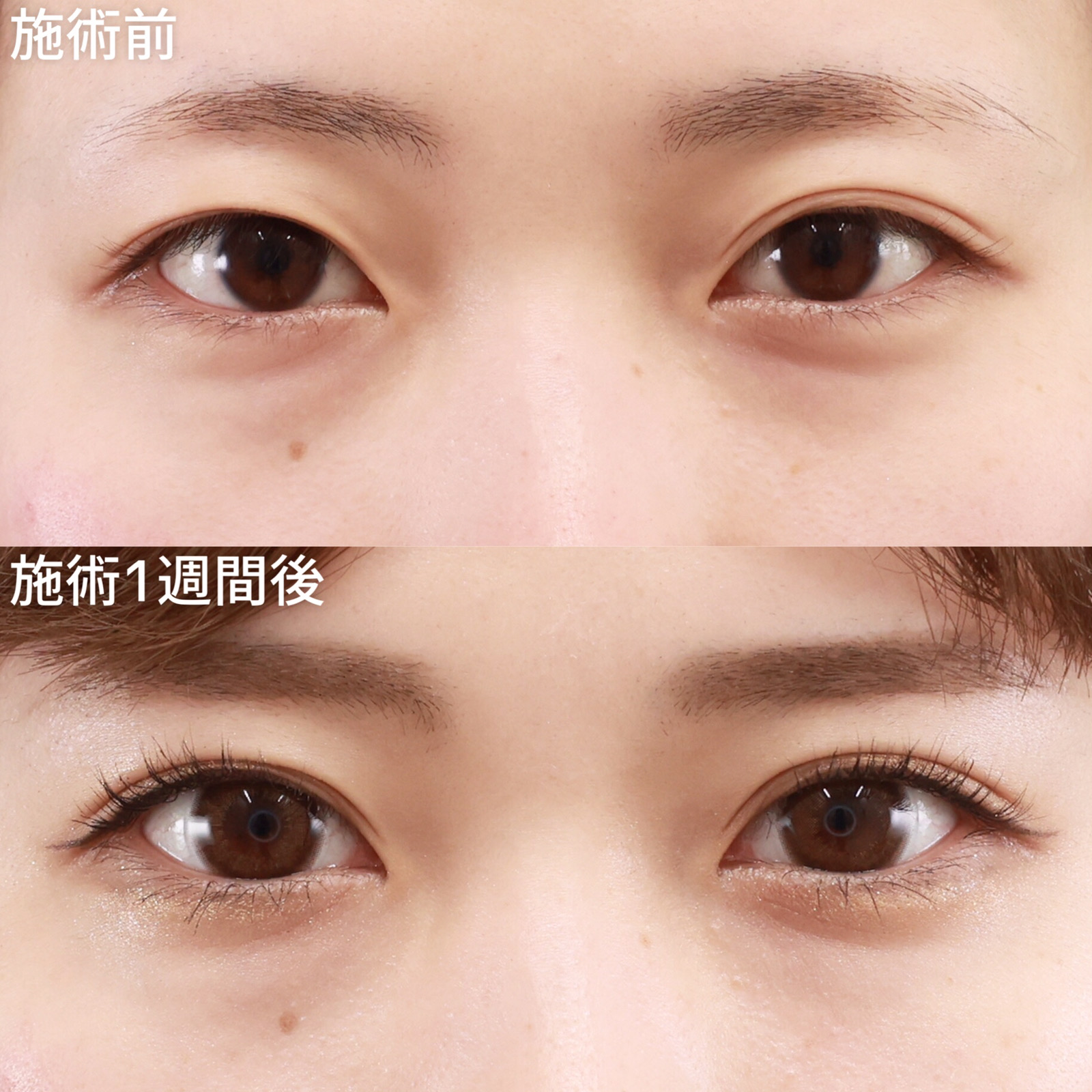 クイックコスメリングの症例写真 施術前後