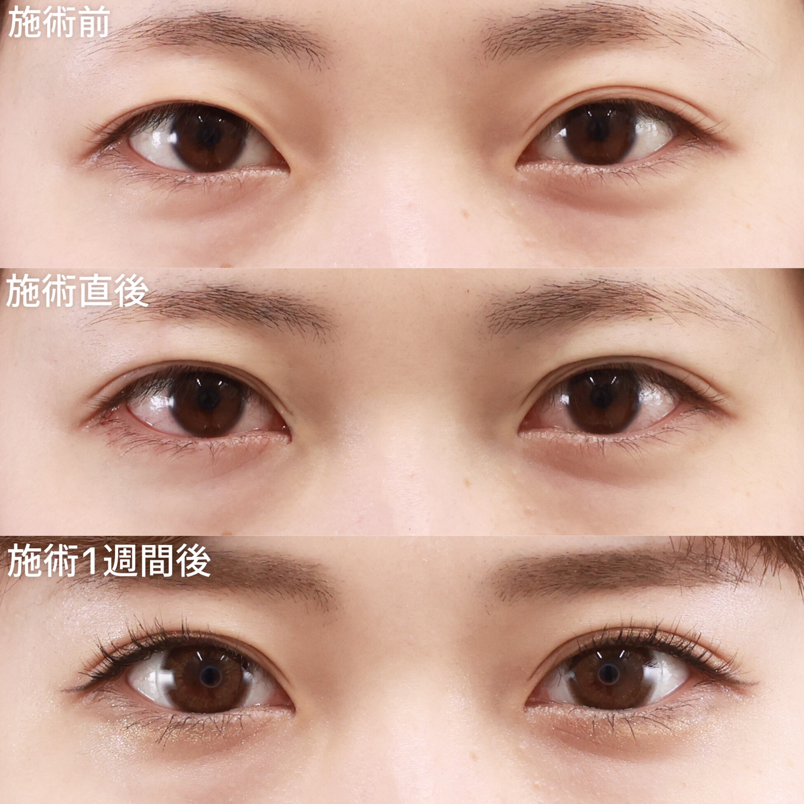 クイックコスメリングの症例写真 施術前後