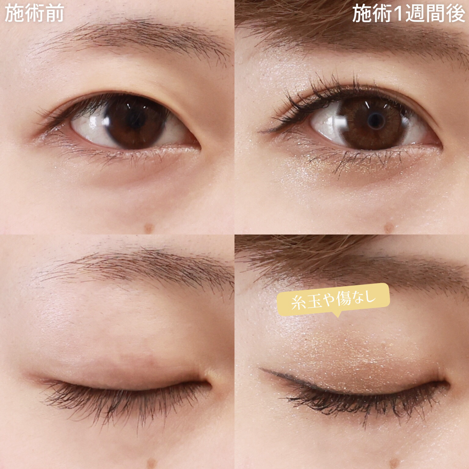 クイックコスメリングの症例写真 施術前後