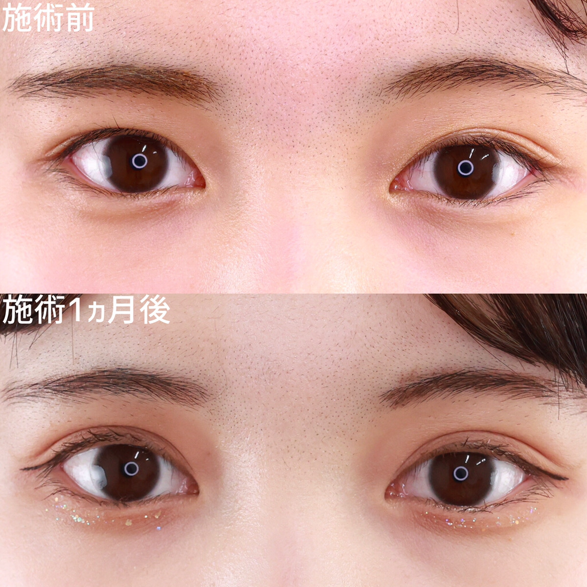 二重埋没法/目元：その他の症例写真 施術前後 