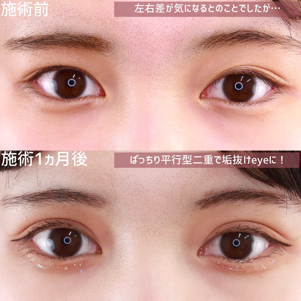 二重埋没法/目元：その他の症例写真 施術前後 