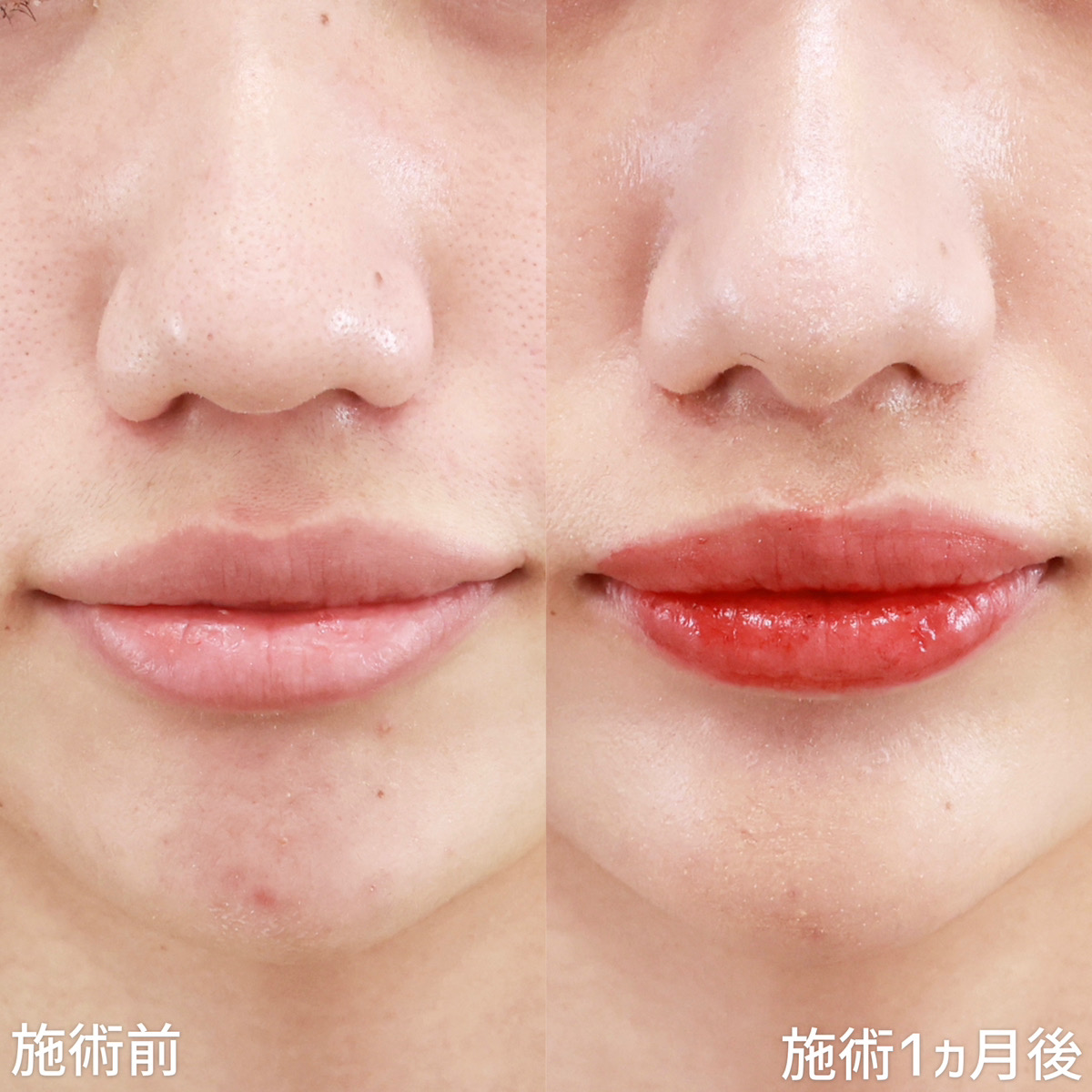 Cカール・猫手術の症例写真 施術前後 1週間