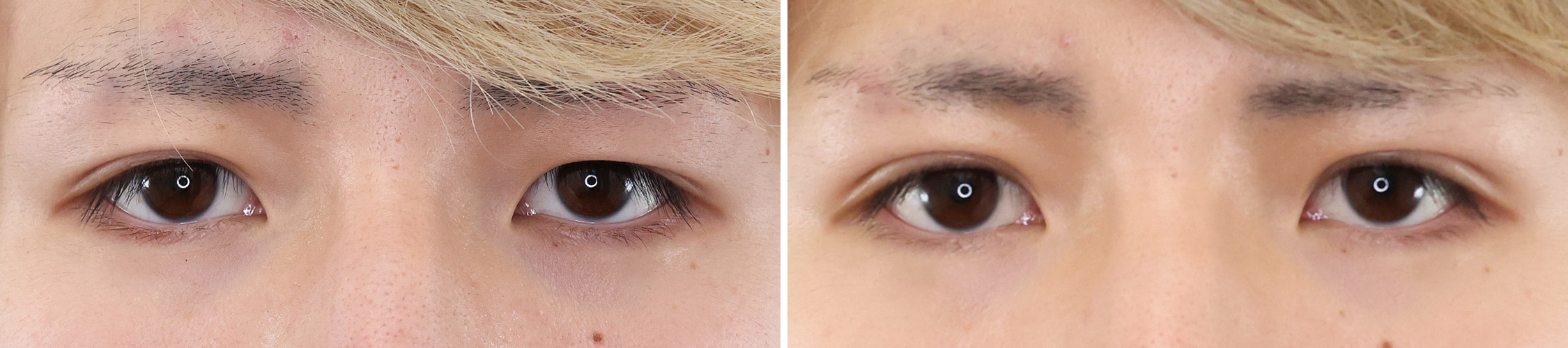 左右非対称だったまぶたを揃いのクッキリ二重に！