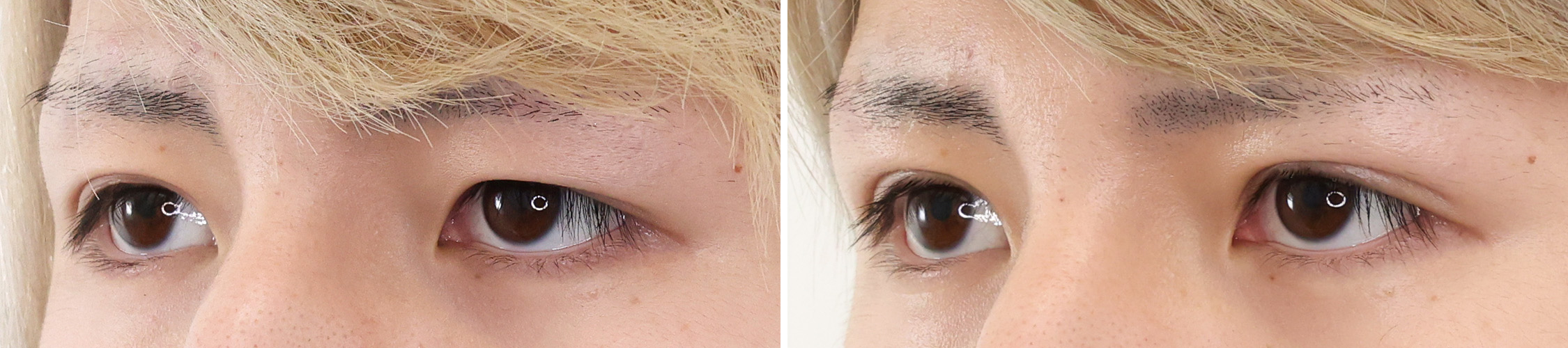 二重埋没法の症例写真 施術前後 １ヵ月