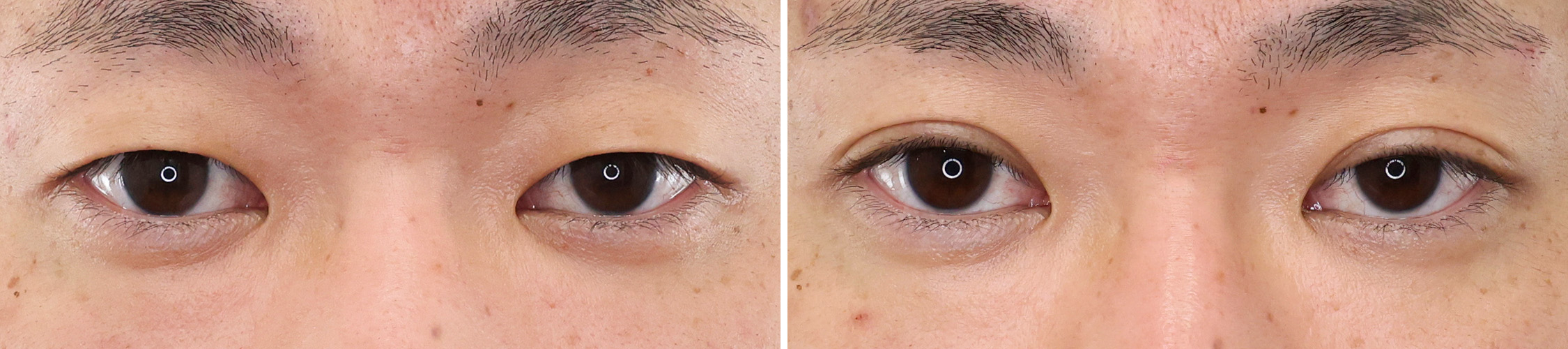 眠たそうな目元から一転、快活な印象に！二重埋没法でパッチリ二重