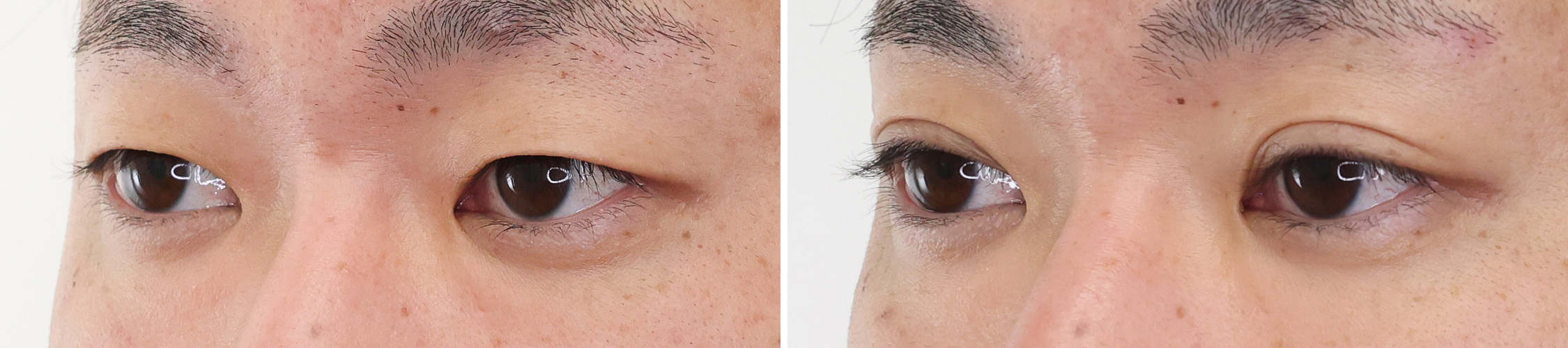 二重埋没法の症例写真 施術前後 １ヵ月