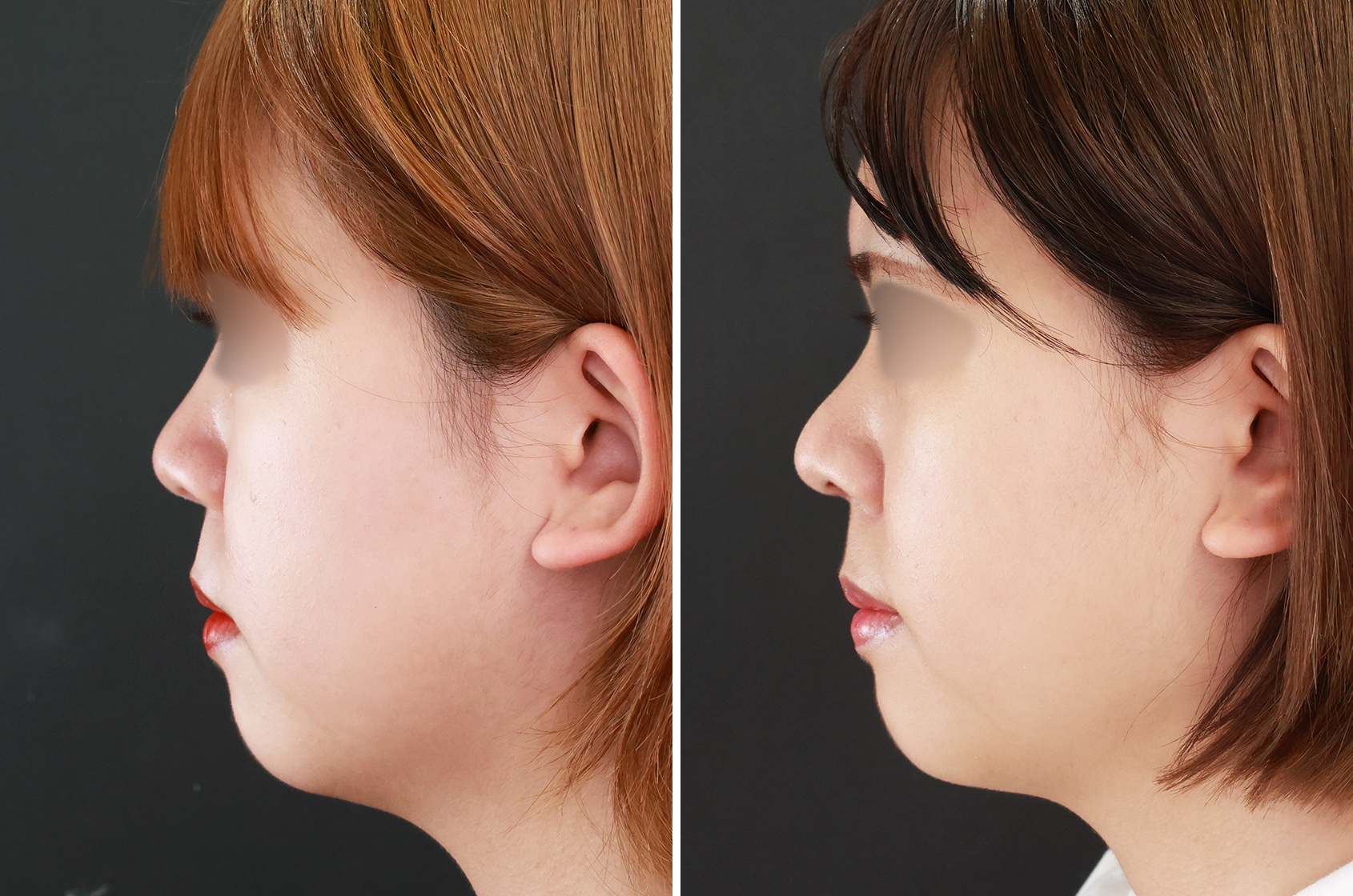 自然なノーズライン【鼻尖形成で美鼻に】