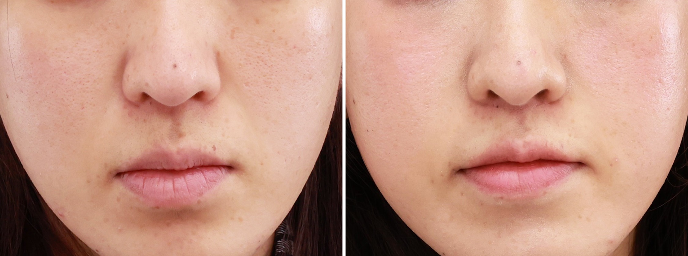 今大人気！鼻の下を短くする人中短縮術