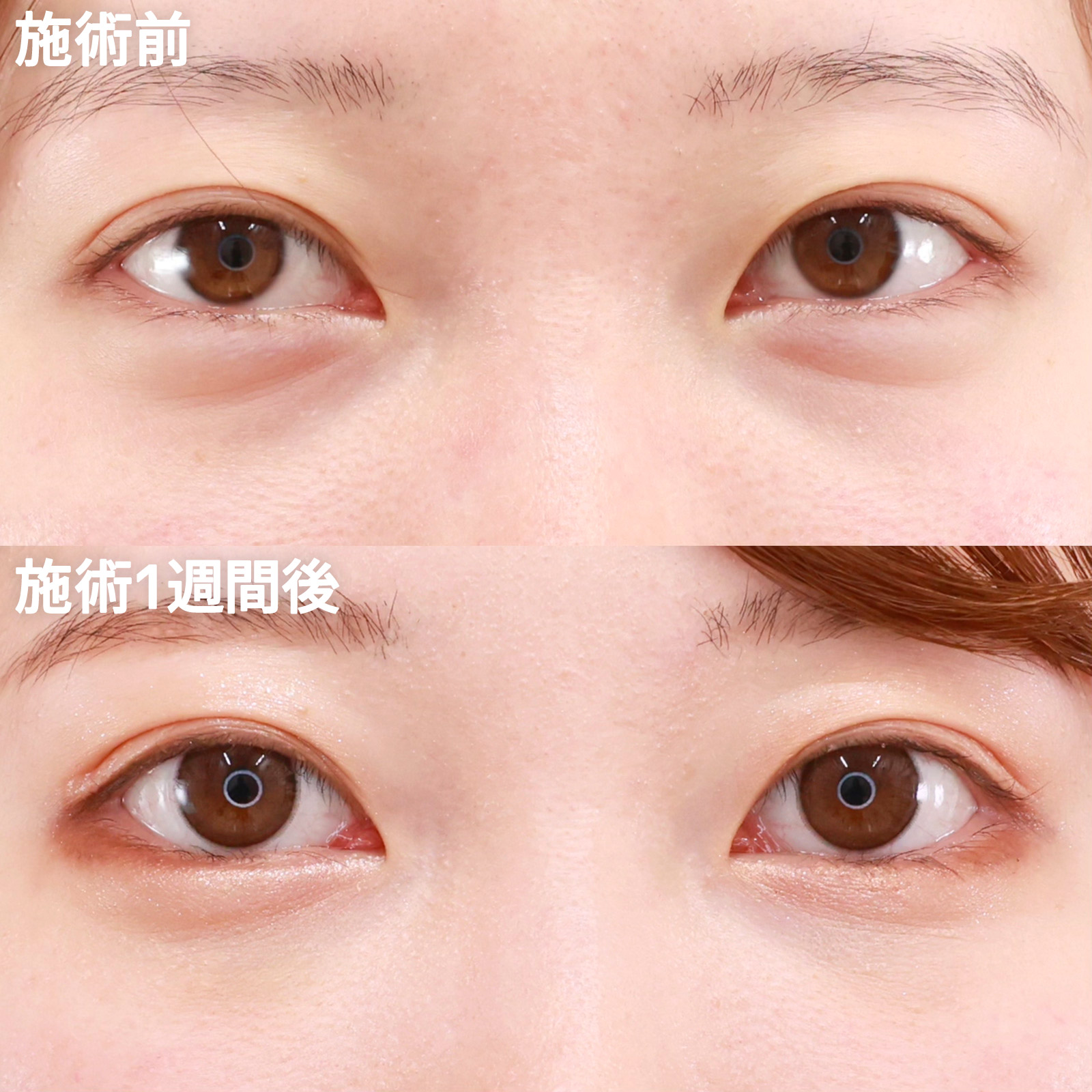 ダウンタイムが取れない方におすすめの “切らない” グラマラスライン