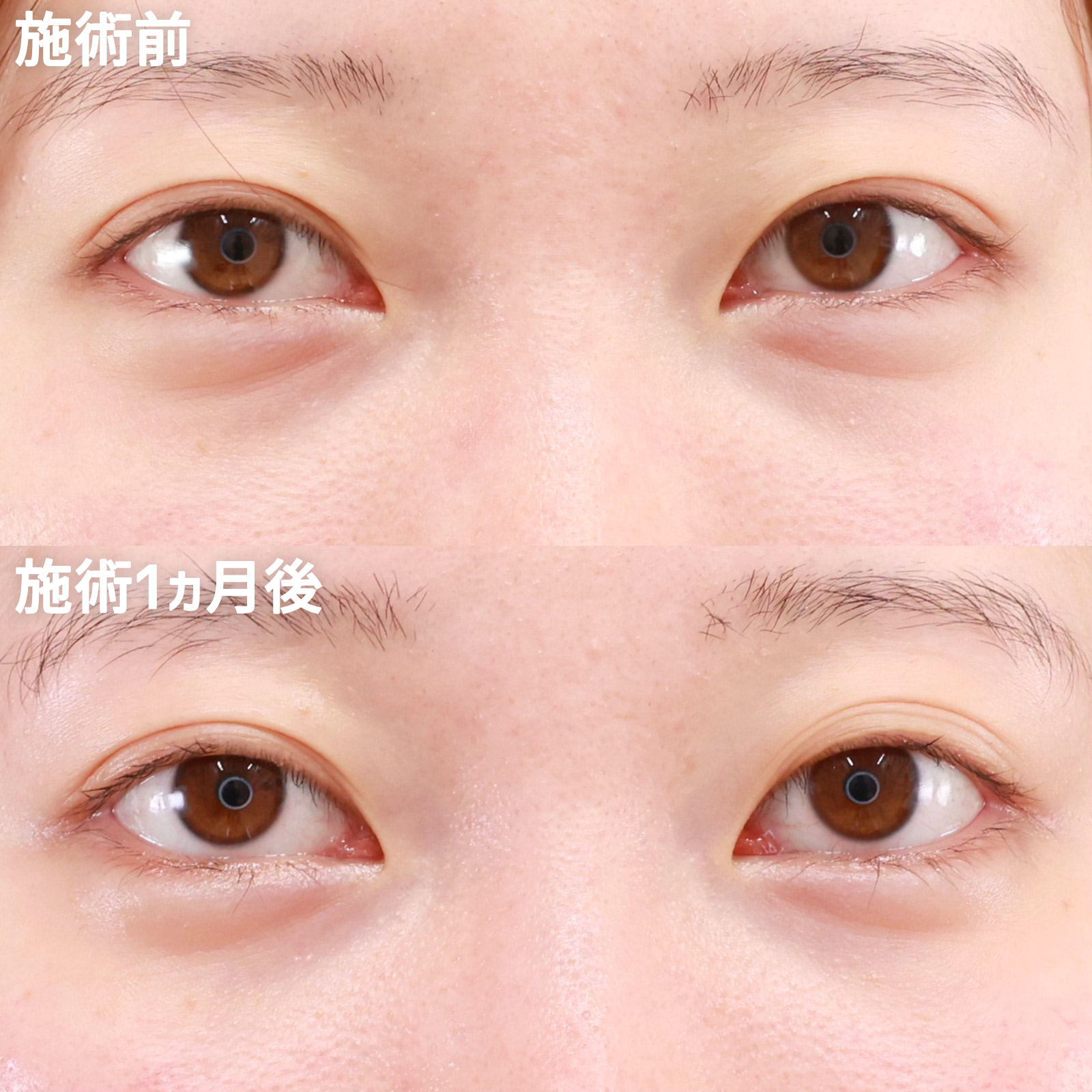 グラマラスライン（タレ目形成）の症例写真 施術前後 